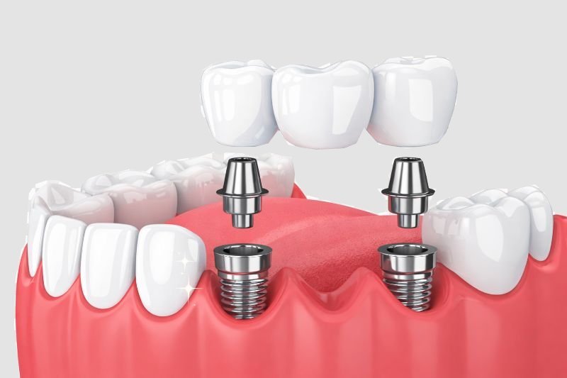 Modelo dental con implante de titanio